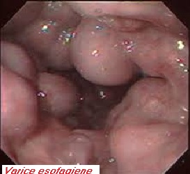varicoza cu boala hepatica